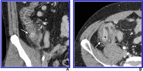 diverticulosis icd-10|Colonic Diverticulosis